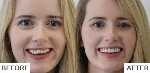 Smile Makeover Before and After